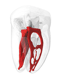 Er:YAG laser root canal debridement — study figure