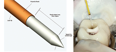 Er:YAG laser root canal debridement — study figure