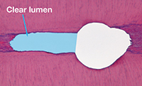 Er:YAG laser root canal debridement — study figure