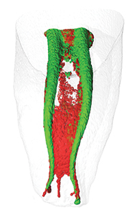 Er:YAG laser root canal debridement — study figure