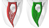Er:YAG laser root canal debridement — study figure