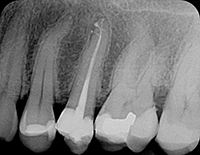 Er:YAG laser root canal debridement — study figure