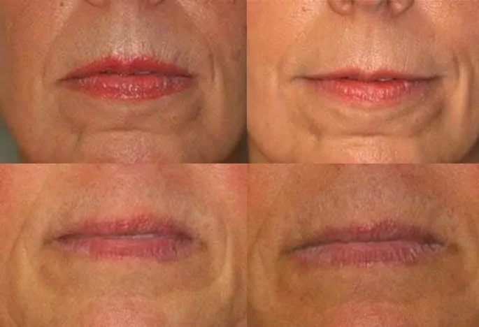 liplease arizona center for laser dentistry